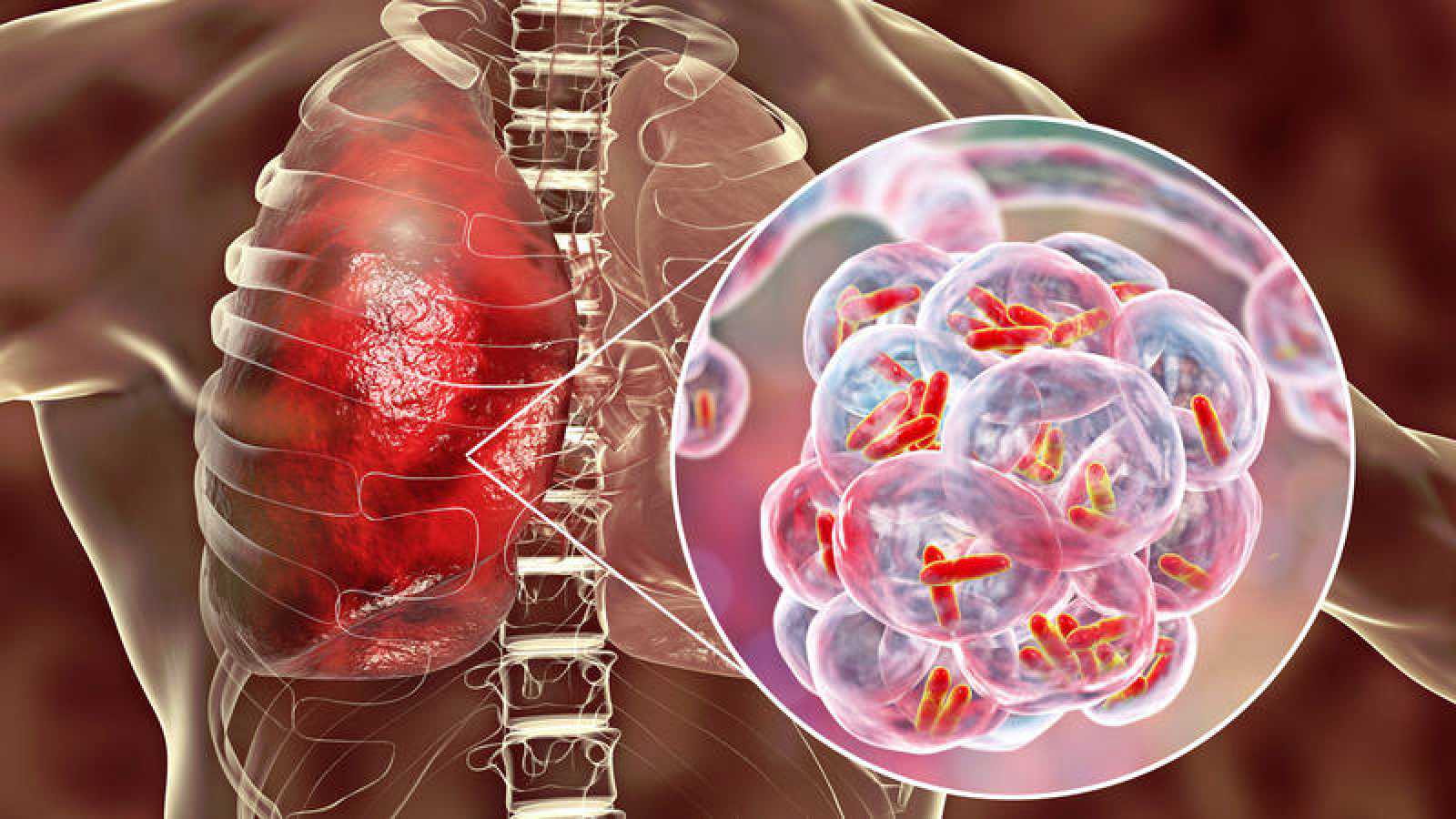 Imagen dibujada mostrando un pulmón y la enfermedad tuberculosis